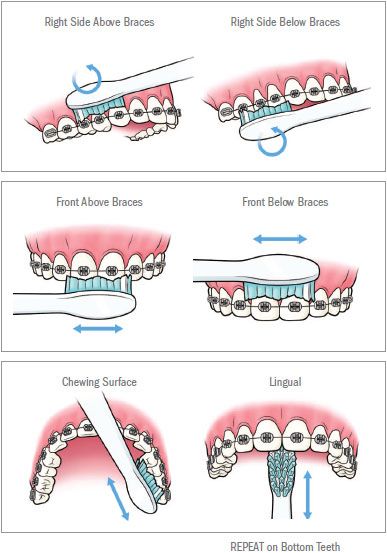 braces-brushing-guide